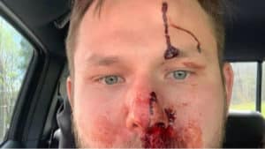 Recibe un tiro en la cara de otro cazador y sube su foto para concienciar sobre las normas de seguridad