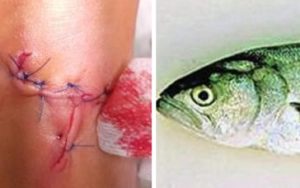 Identifican el pez que mordió y seccionó un tendón a una mujer en una playa de Alicante